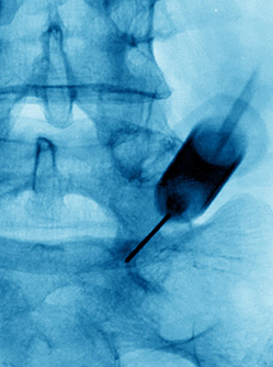 Cliché d'une infiltration lombaire radioguidée - MACSF