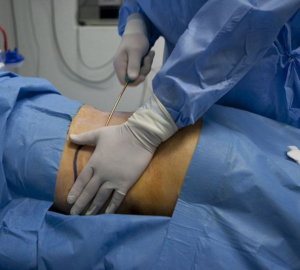 Un chirurgien pratique une lipoaspiration des hanches - MACSF