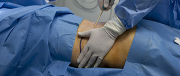 Un chirurgien pratique une lipoaspiration des hanches - MACSF