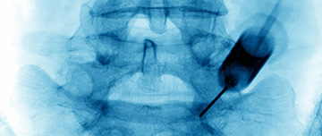 Cliché d'une infiltration lombaire radioguidée - MACSF