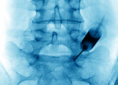 Cliché d'une infiltration lombaire radioguidée - MACSF